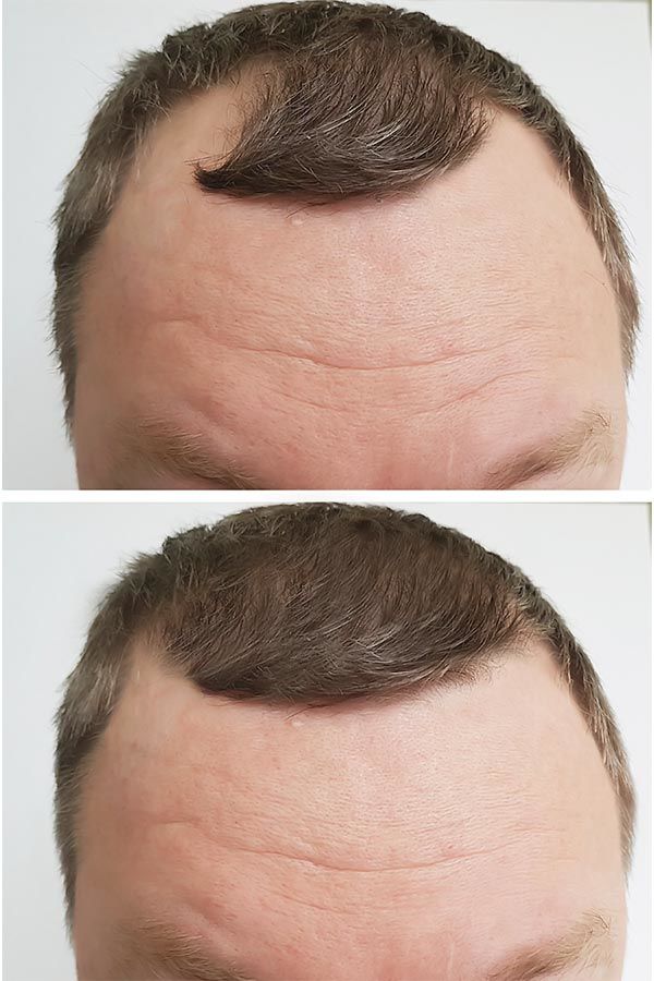 Is A Hair Transplant Effective? #hairtransplant