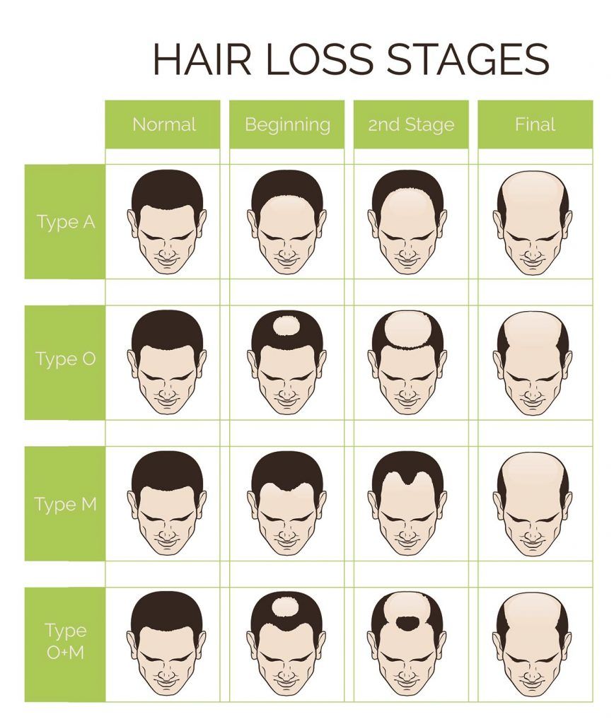 Receding Hairline Tips Baldness 868x1024 