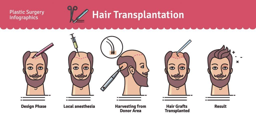 Hair transplantation #recedinghairline